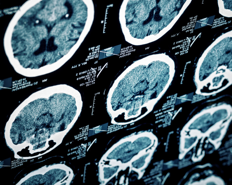 Image of an MRI brain scan 